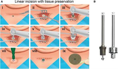 Minimally invasive surgery as a new clinical standard for bone anchored hearing implants—real-world data from 10 years of follow-up and 228 surgeries